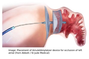 Image: Placement of AmuletAmplatzer device for occlusion of left atrial appendage (image is courtesy of Abbott / St Jude Medical)