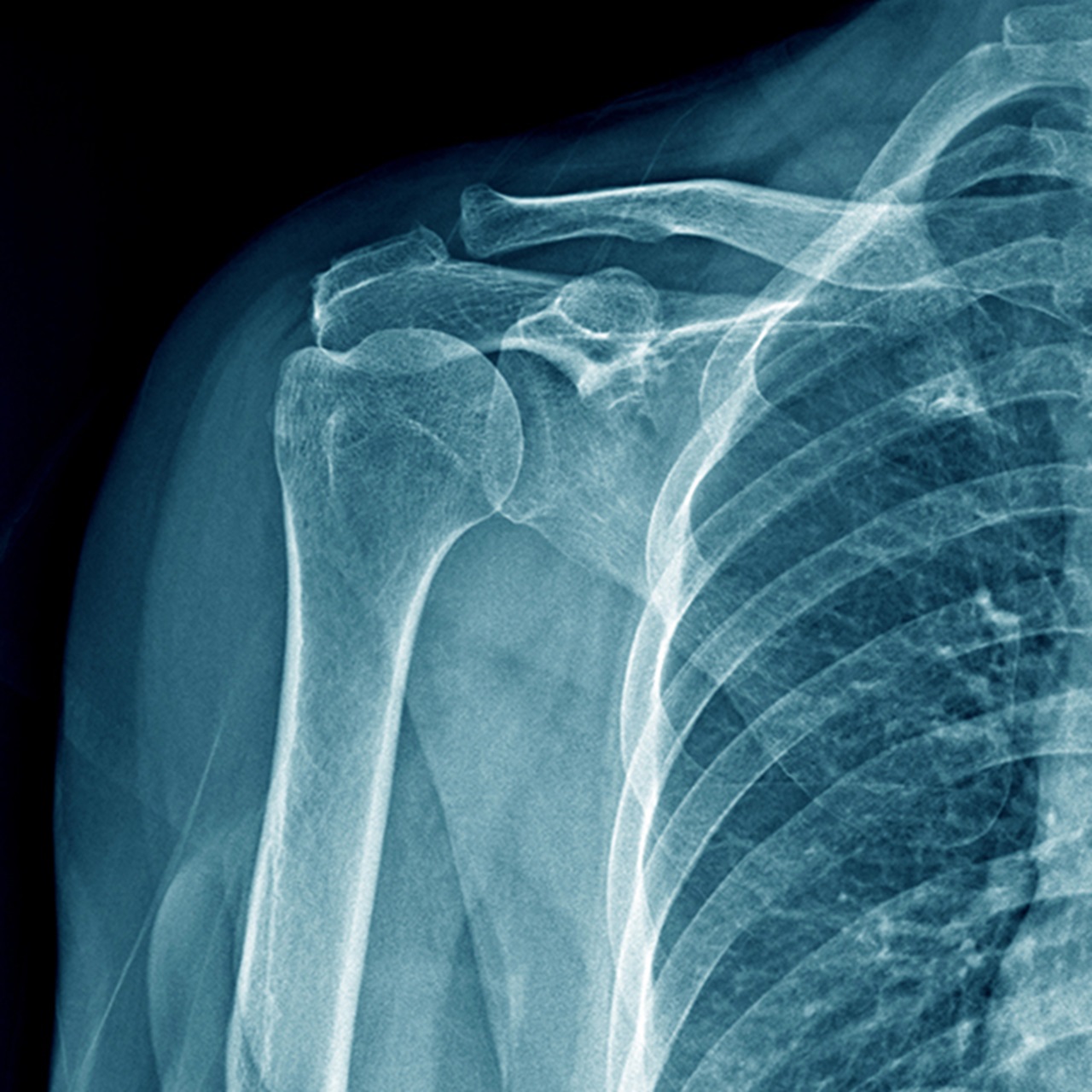 London Bridge orphopaedic treated conditions - shoulder