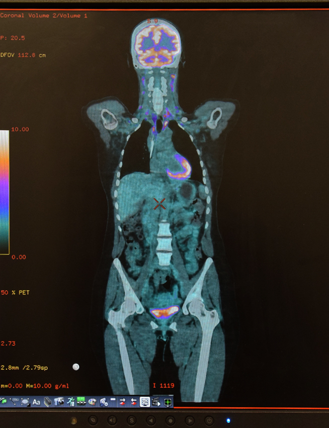Scan-cancer-care