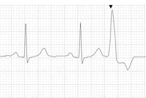 heartbeat Ectopic