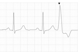 heartbeat Ectopic